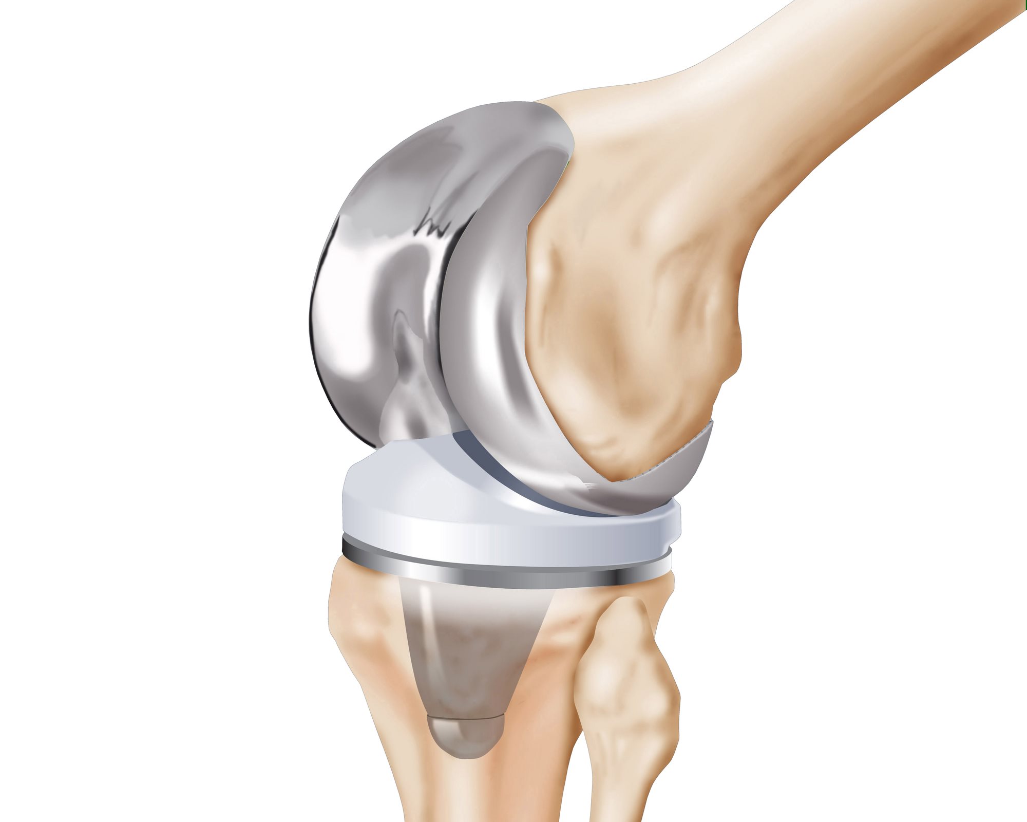 Knee replacement component